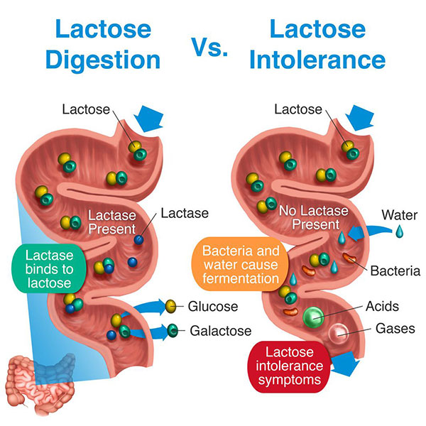 Quá trình tiêu hóa lactose của người bình thường và người mắc chứng không dung nạp lactose